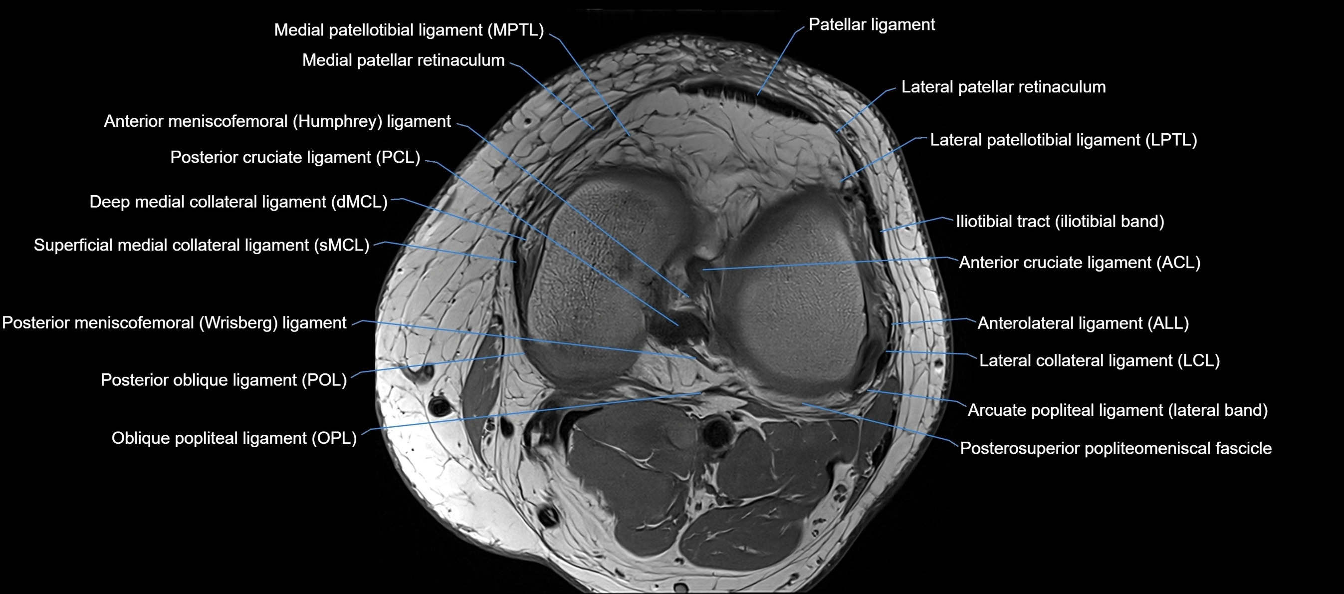 MRI Knee axial  ligaments cross sectional anatomy 3T  radiology  image-img-03001-00027.webp